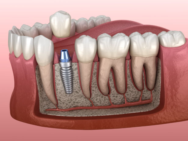 dental implant restoration