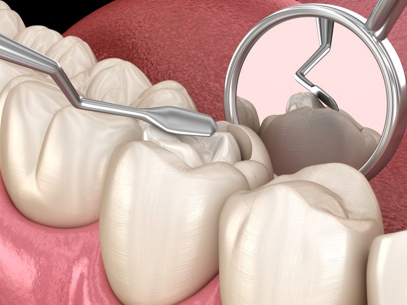 composite-restorations-procedure