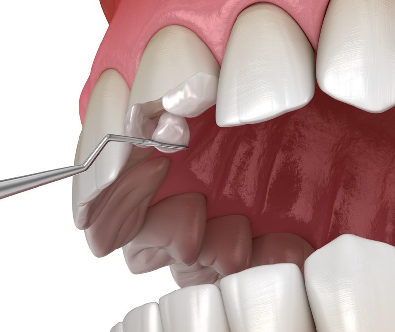cosmetic-bonding-procedure