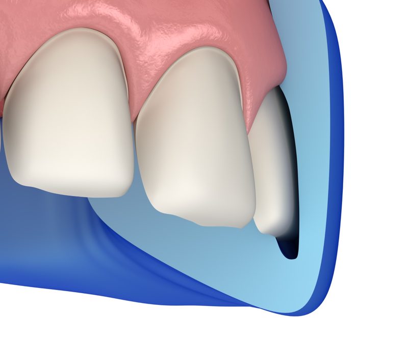 cosmetic-bonding