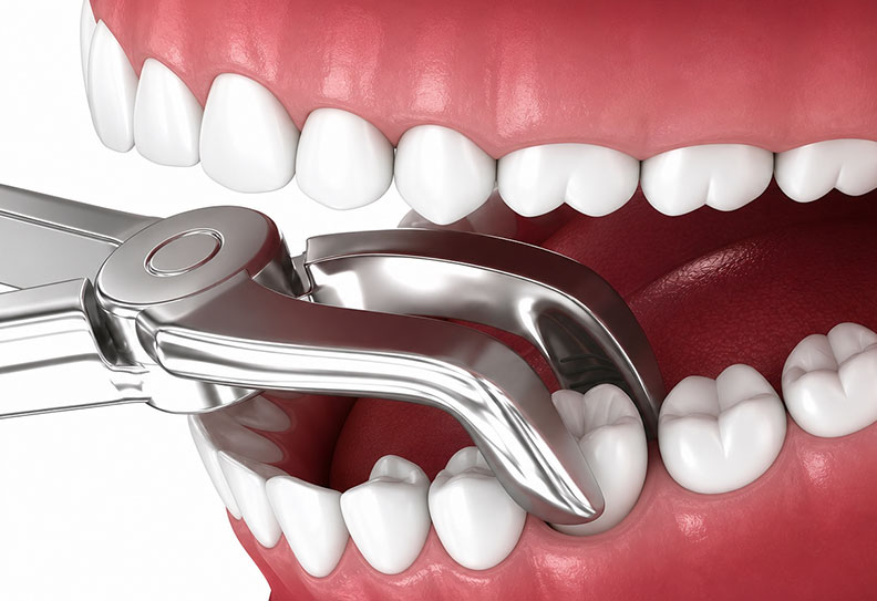 dental-extractions