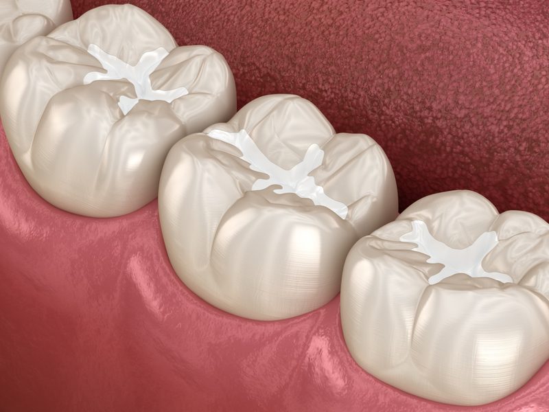 dental-sealants