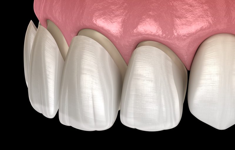dental-veneers