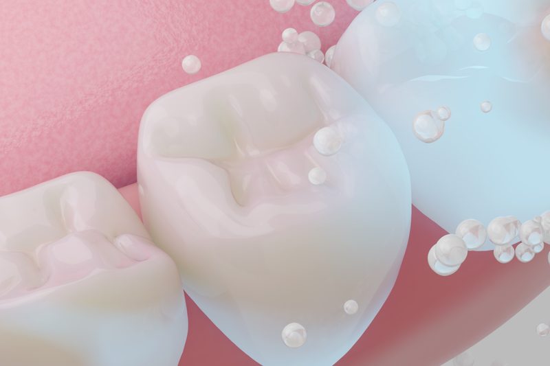 fluoride-treatment