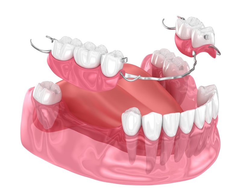 removable-prosthesis