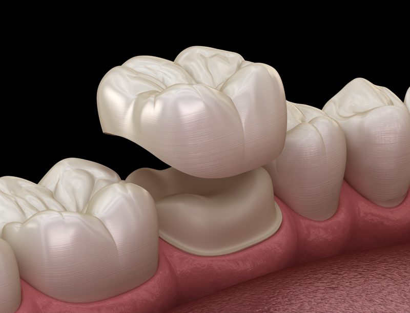 root-canal-crown