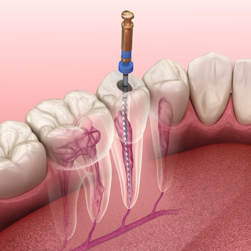 root-canal-illustration