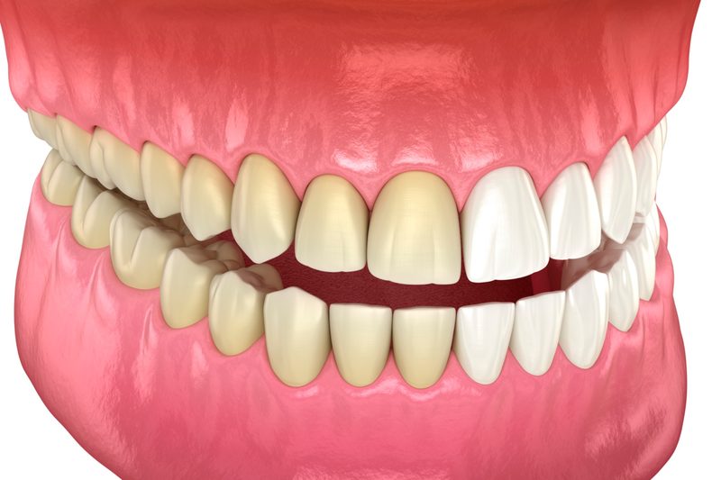 teeth-whitening